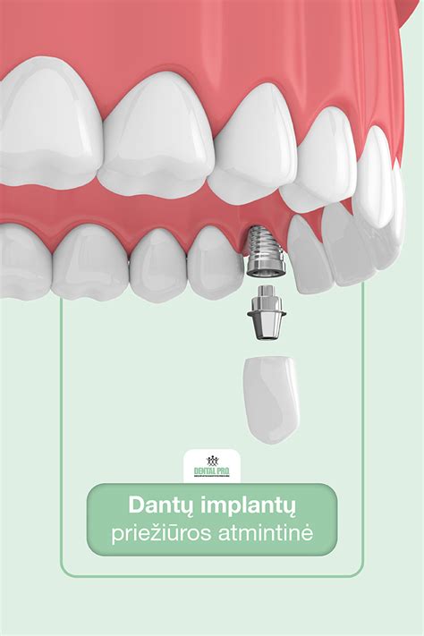 Dantų implantų paviršiaus apdorojimo procesas